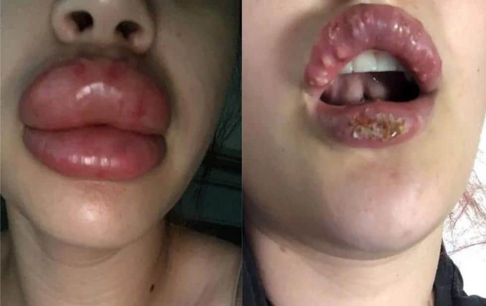 Mujeres van por inyección de labios y salen con herpes y pus