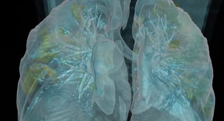 VIDEO: Efectos del Covid-19 sobre unos pulmones sanos