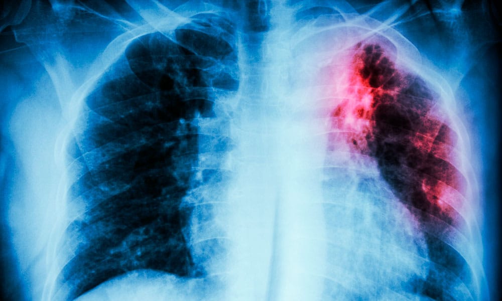Vive BC epidemia… de tuberculosis y sífilis