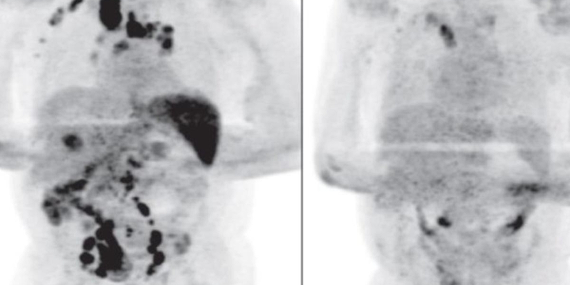 Paciente-se-cura-de-cáncer-tras-contagiarse-de-Covid-19-lo-investigan