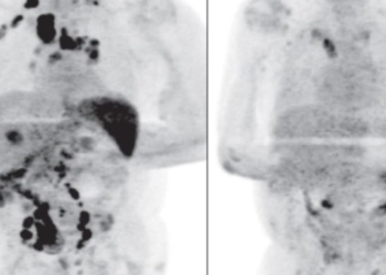 Paciente-se-cura-de-cáncer-tras-contagiarse-de-Covid-19-lo-investigan