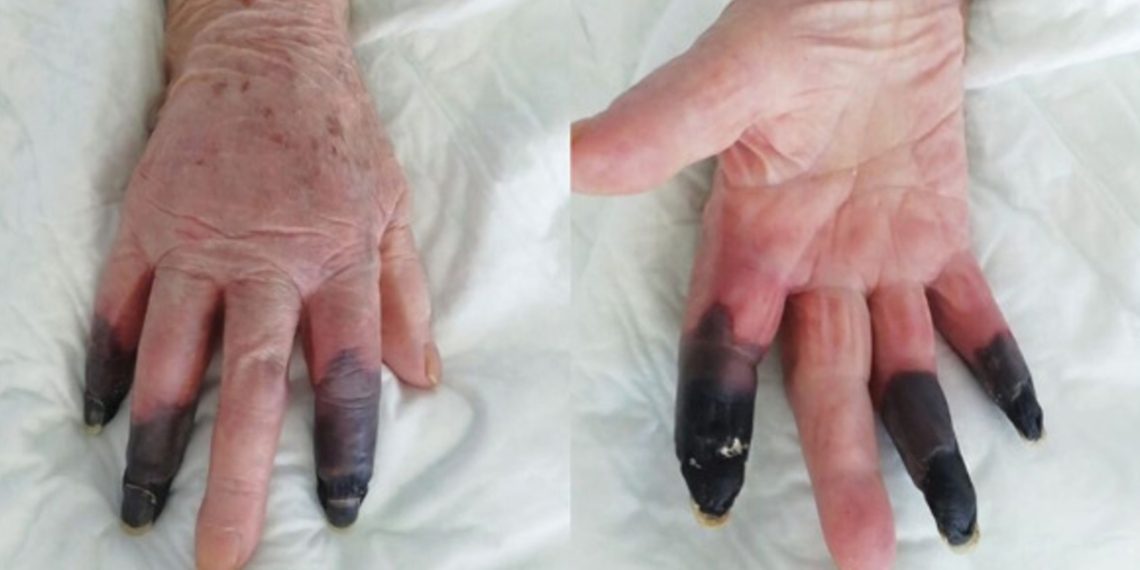 COVID-19 LE PROVOCA GANGRENA A MUJER DE 86 AñOS