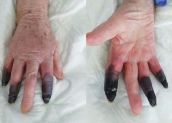 COVID-19 LE PROVOCA GANGRENA A MUJER DE 86 AñOS