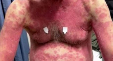 FOTO: Sufre rara erupción en la piel tras recibir vacuna contra Covid-19