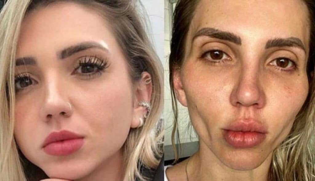 Influencer-se-deforma-el-rostro-tras-bichectomia