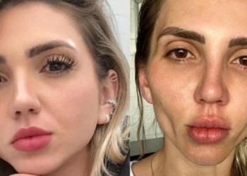 INFLUENCER SE DEFORMA EL ROSTRO TRAS BICHECTOMIA