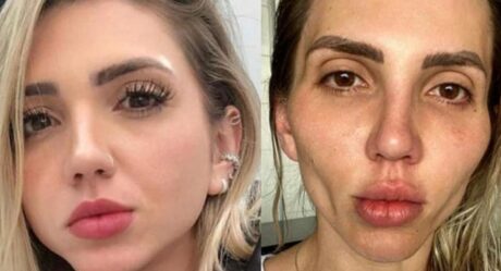 Influencer se deforma el rostro tras bichectomia