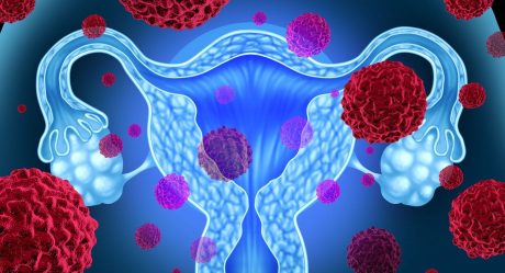 Secretaría de Salud invita a mujeres a prevenir cáncer de ovario