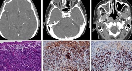 Hombre pierde la visión por bacteria tras contraer Covid-19