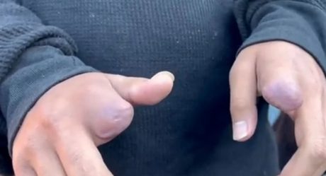 Adolescente se niega a vender droga y le mutilan dedos