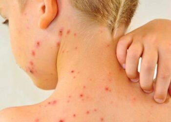 Sube a 15 los contagios por sarampión en Baja California